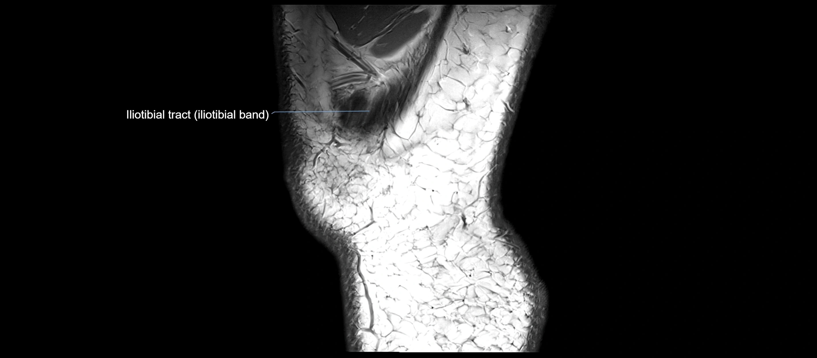 MRI sagittal  ligaments cross sectional anatomy 3T  radiology  image-img-00001-00045.webp